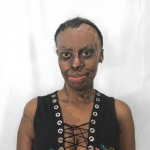 BURN SURVIVOR , SOLARA SHARES INSPIRING STORY OF STRENGTH, BRAVERY & SELF-LOVE