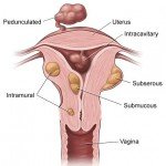 NO DRUG CAN SHRINK OR PASS OUT FIBROID -SURGEON