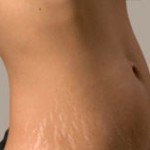 FIVE WAYS TO GET RID OF STRETCH MARKS NATURALLY