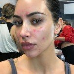 KIM KARDASHIAN BARES IT ALL ABOUT HER STRUGGLE WITH PSORIASIS