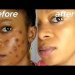 10 WAYS TO CLEAR SPOTS NATURALLY